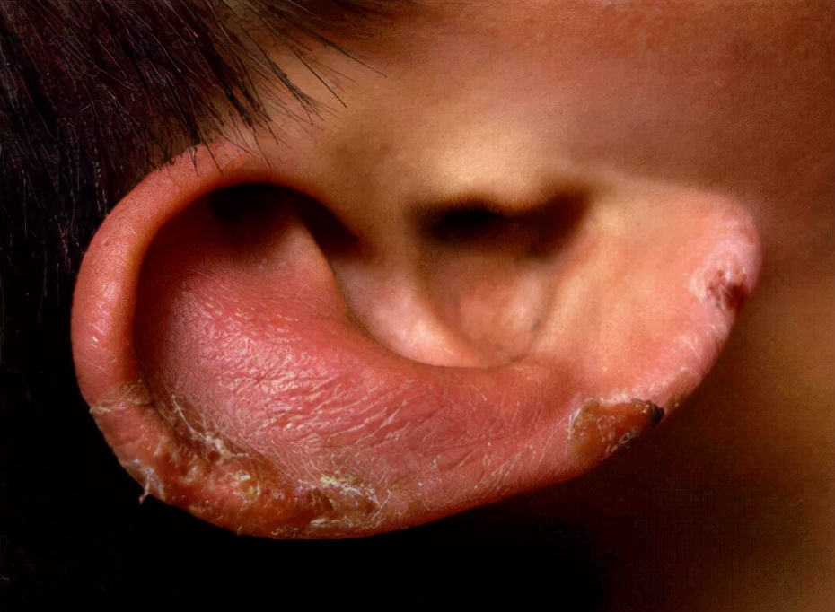 一到冬天就复发?小菌衣教你几招远离冻疮烦恼