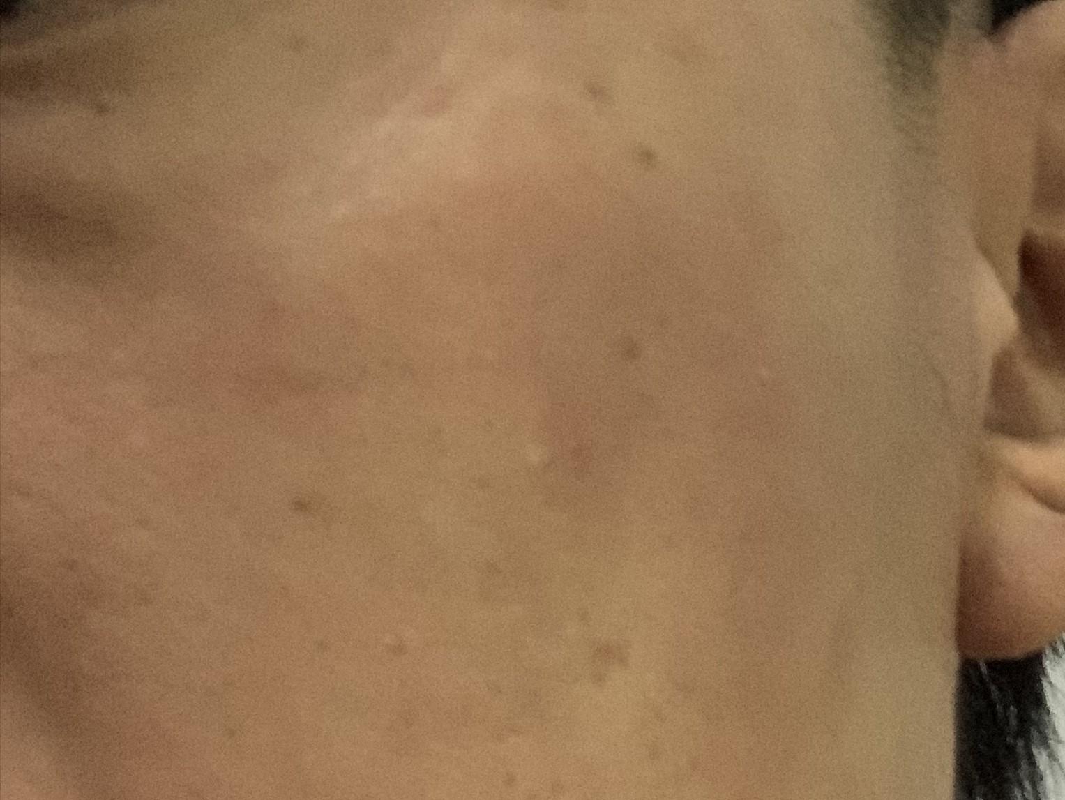 17岁的孩子身上脸上长了好多痘痘,17岁女孩脸上长好多痘痘怎么办