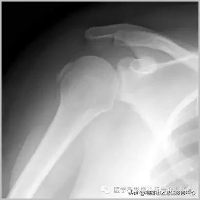 软组织钙化是不是骨化性肌炎,软组织钙化或骨化