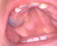 小孩长牙牙龈肿了怎么办,孩子长牙牙龈肿痛怎么办