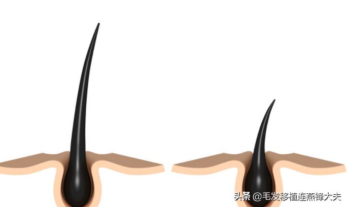 毛囊脱发怎么治疗最有效,治疗脱发有什么办法吗