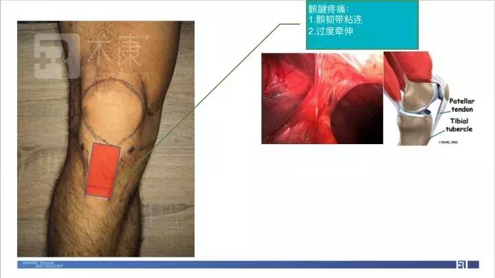 前叉术后两个月伤口处伸直会疼,前叉术后第11天的状态
