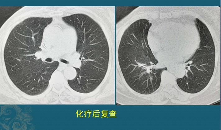分享癌症患者康复,肿瘤病人的分享