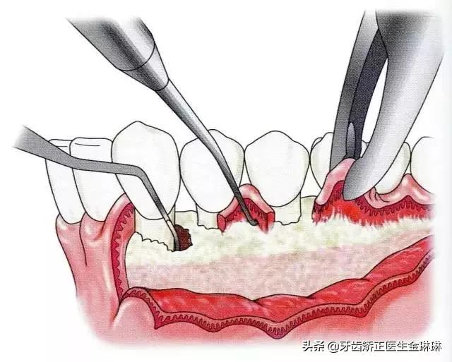 有肾病的人得了牙周炎怎么办,得了牙周炎用什么牙膏刷牙最好