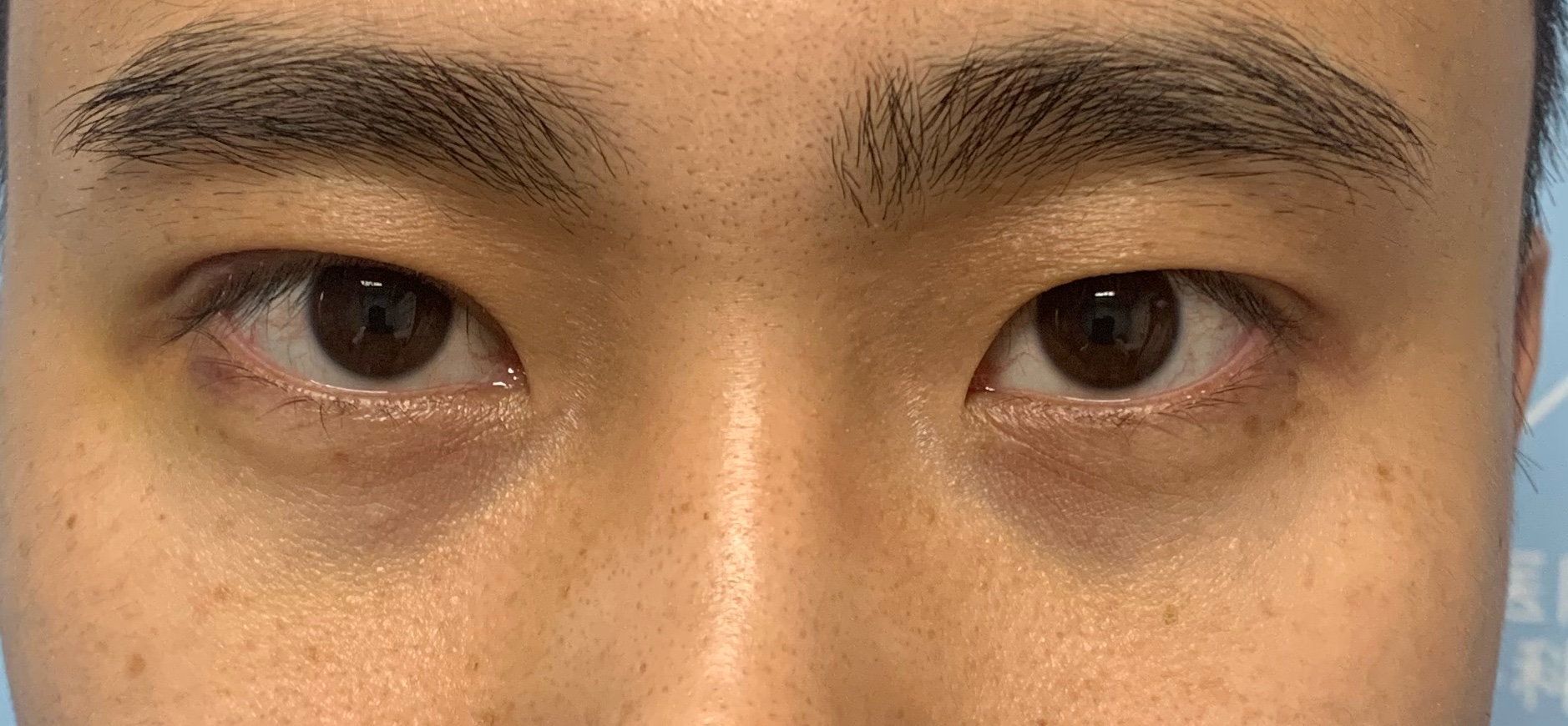 单眼皮怎么贴出平行双眼皮,单双眼皮现实中好看吗