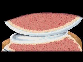 半月板损伤康复,儿童半月板损伤