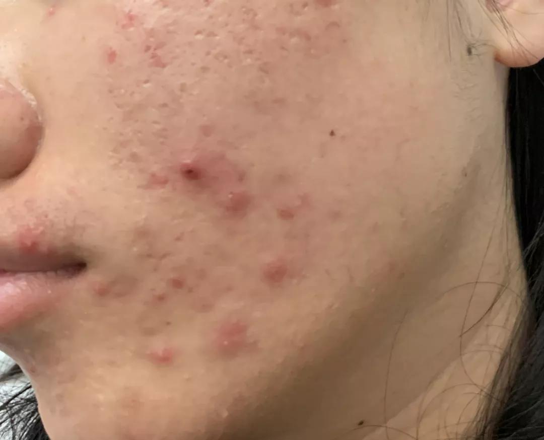 异维a酸软胶囊治疗痘痘多久见效,异维a酸抑制雄性激素治疗痘痘吗