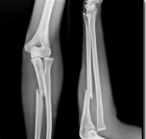 腰椎滑脱和腰椎间盘突出哪个严重,想知道腰椎间盘突出是怎样引起的