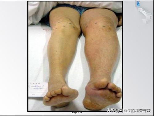 双腿静脉血栓肿怎么治疗,双腿血栓腿肿是什么原因