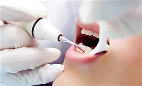 蚌埠三院洗牙真实经历和感受,第一次洗牙什么感觉