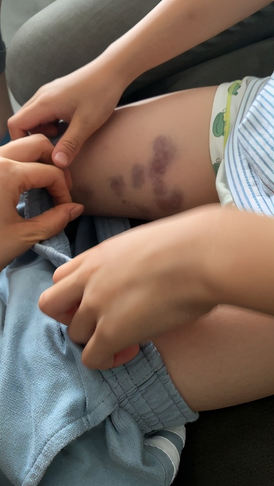 麻辣调查：乐山一幼儿园老师掐青孩童只是“管教过当”？家长不认可，园方不回应