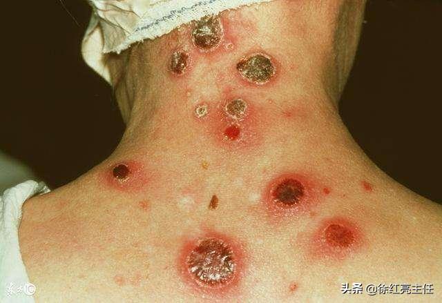 手掌脚掌红疹是梅毒吗,手掌唯一一个红疹会是梅毒吗