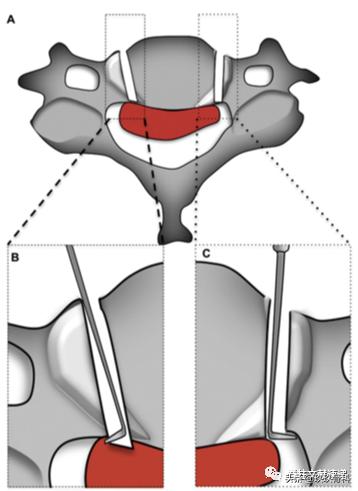 acaf手术适应脊髓型颈椎病吗,acaf术后康复方法