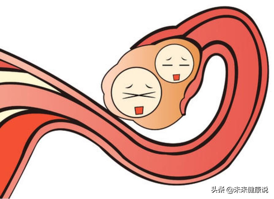 丈夫闯“大祸了”，妻子同房后下腹疼痛难忍，疑是“黄体”破裂