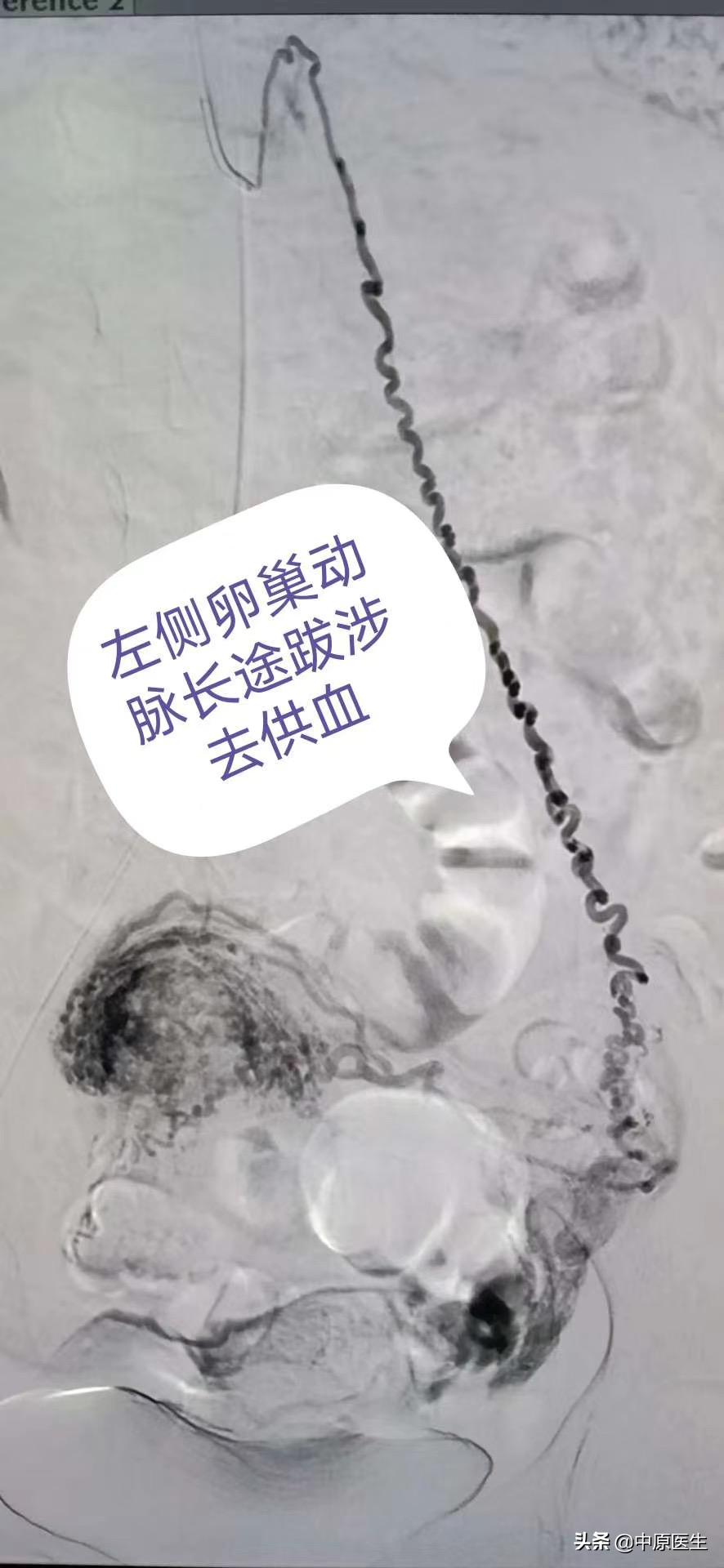 如果自己强烈要求剖宫产可以吗,专家提醒不能生育