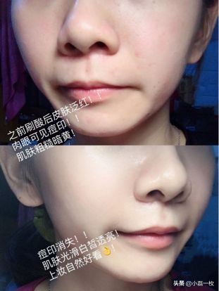 刷酸后爆痘持续多久,刷酸爆痘怎么处理