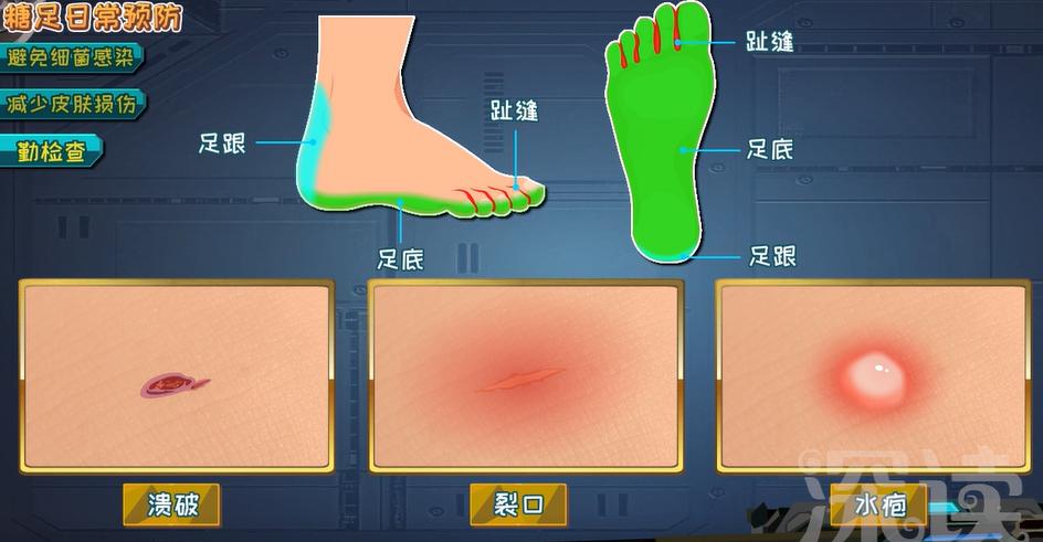 糖尿病足截肢步骤,干性糖足坏疽必须截肢吗