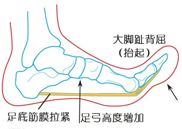 骨刺与跖筋膜炎怎么治疗,足跟痛骨刺与跖筋膜炎