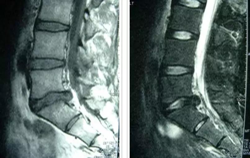 青少年一跑步就腰痛,青少年腰痛是什么原因引起的