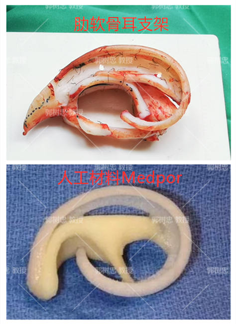 小耳畸形三期主要是做什么,大小耳畸形能好吗