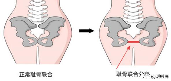 孕妇*处私**骨头痛是耻骨联合分离吗，疼的不能走路，不能翻身怎么办