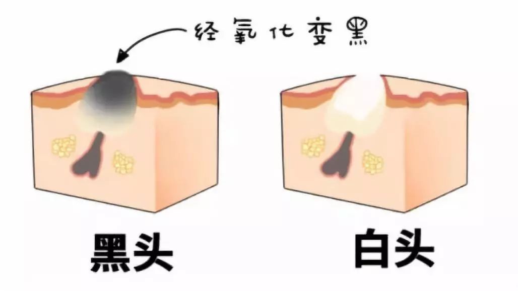 简单省钱去黑头的小妙招,懒人去黑头小妙招一周去黑头
