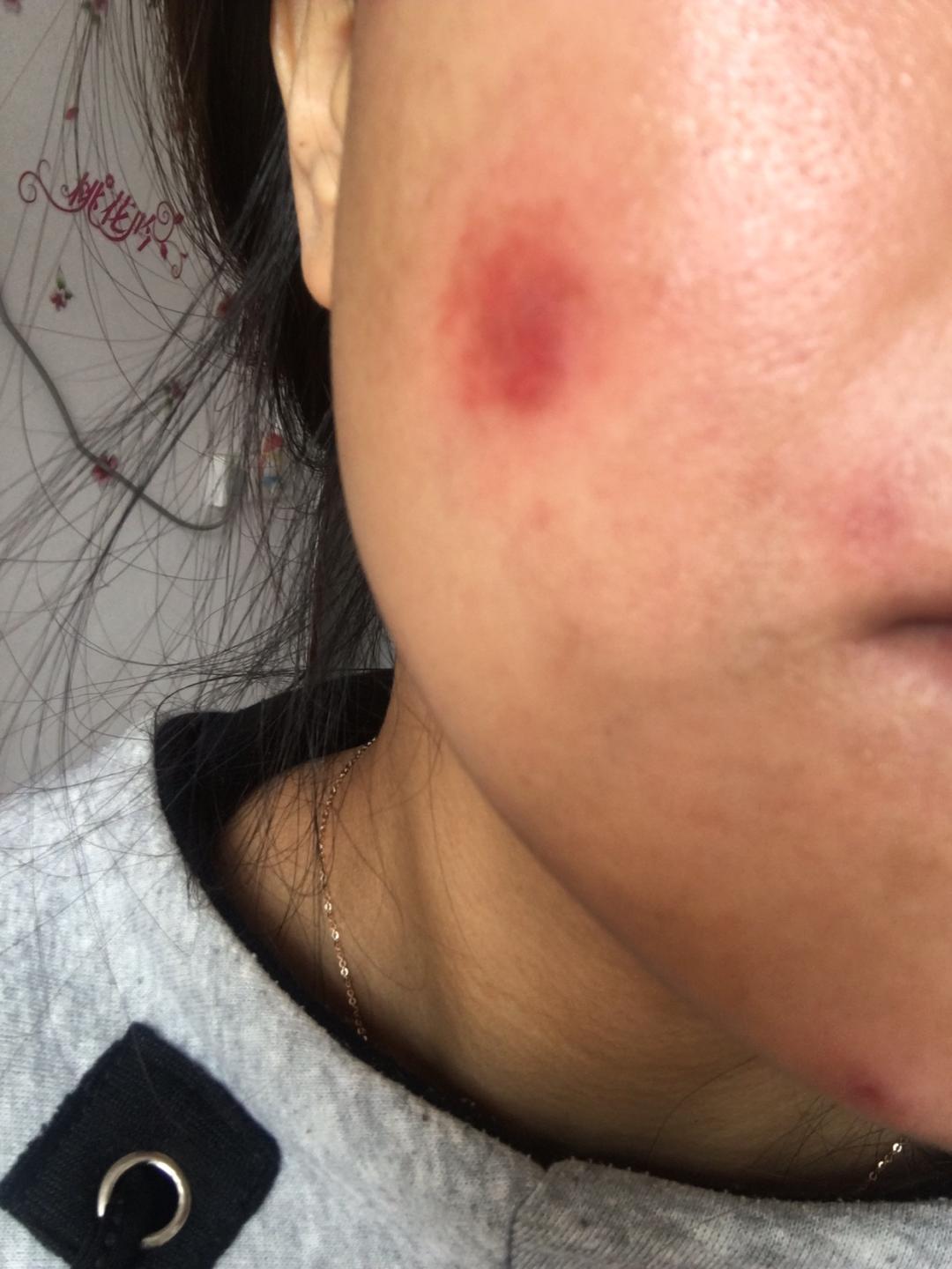 过敏角质层受损,过敏角质层损坏