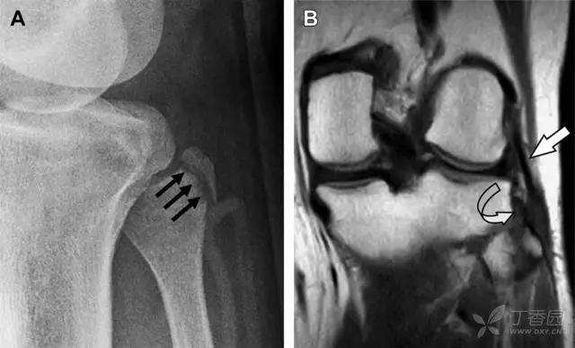 放射科夜班病例大全,放射科容易漏诊的骨折