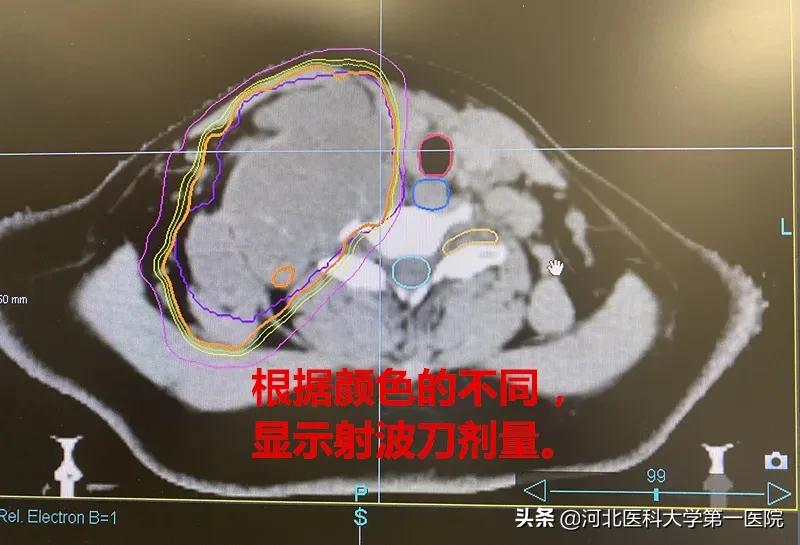 神奇魔法刀,一点就消!点亮肿瘤绝境患者,再生的希望之光