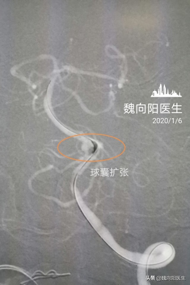 放入支架腰疼怎么办,支架后头晕怎么回事