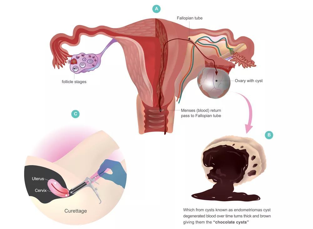 巧克力囊肿适合哪种试管方案,试管巧克力囊肿需要做宫腔镜吗