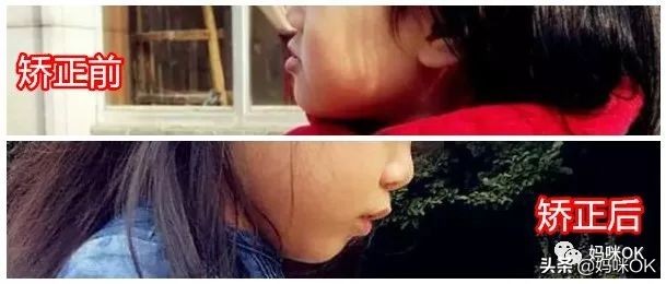 预防乳牙不齐的方法,牙不齐需要乳牙期干预么