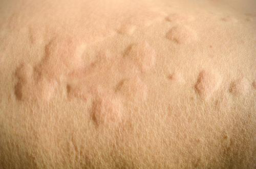 如何处理春季高发皮肤病,冬季皮肤病预防