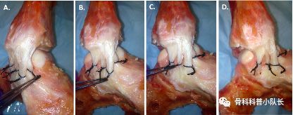 崴脚超过24小时是热敷还是冷敷,崴脚超过48小时是热敷还是冷敷