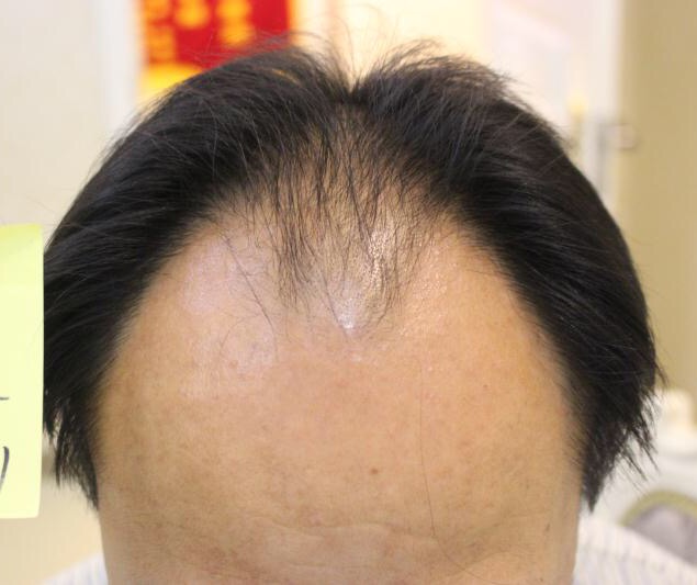 脱发后怎么判断毛囊是否萎缩,雄激素脱发的毛囊萎缩症状