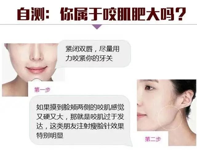 打瘦脸失败的案例,打瘦脸针出事故