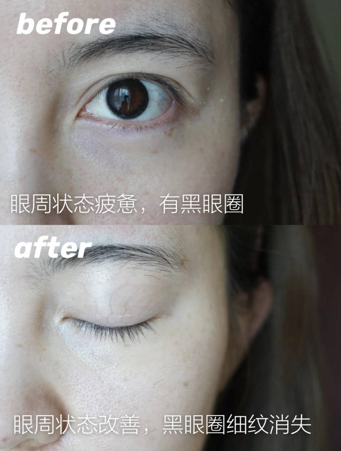 眼睛没有细纹需要眼膜吗,眼膜有用吗能去皱纹吗