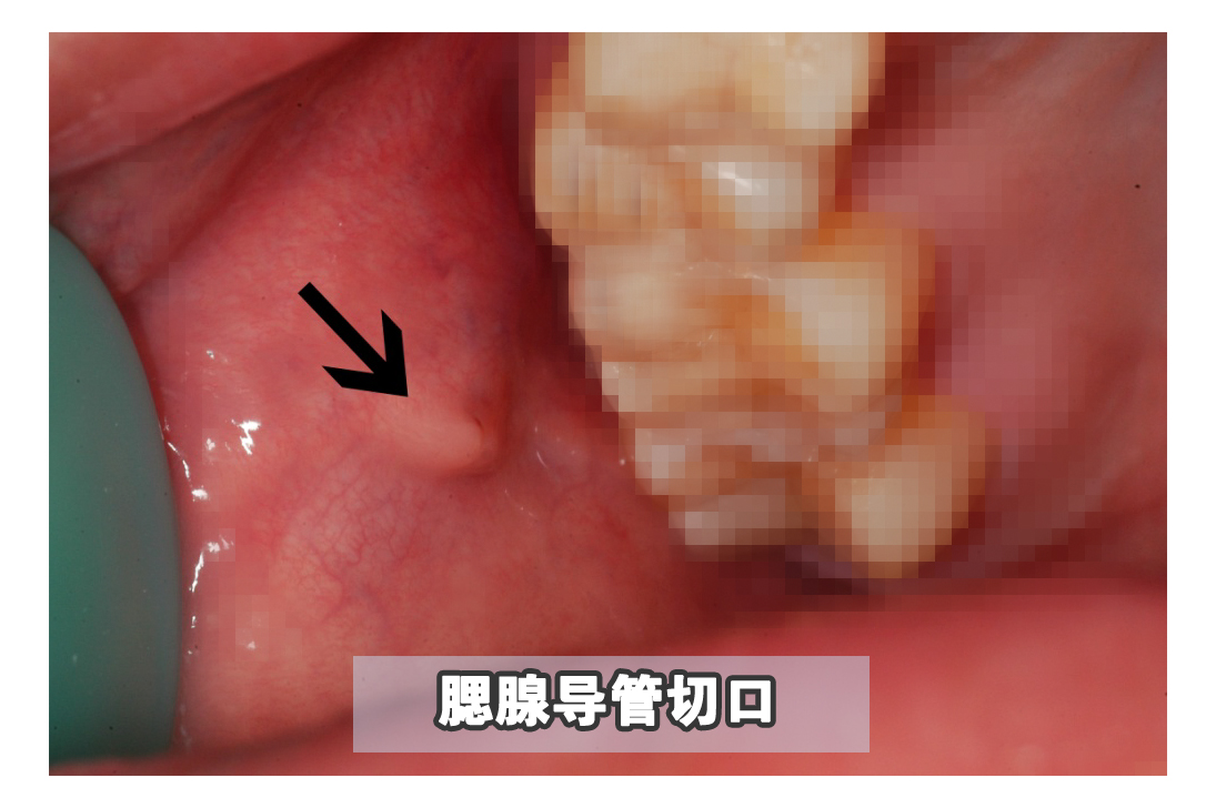嘴里长了一个肉揪是怎么回事,嘴里长了肉疙瘩是癌症吗