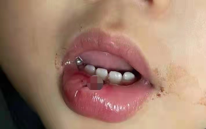 孩子误吞硬币怎么办,孩子误吞硬币怎么解决