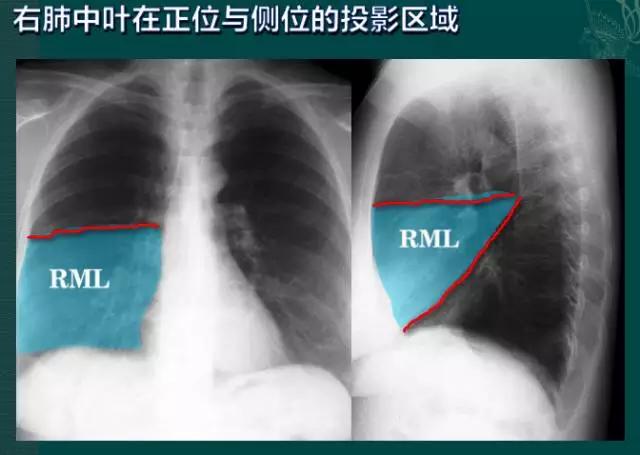 拿到胸片却不会看？送你7个窍门，手把手教你解读胸片（收藏）