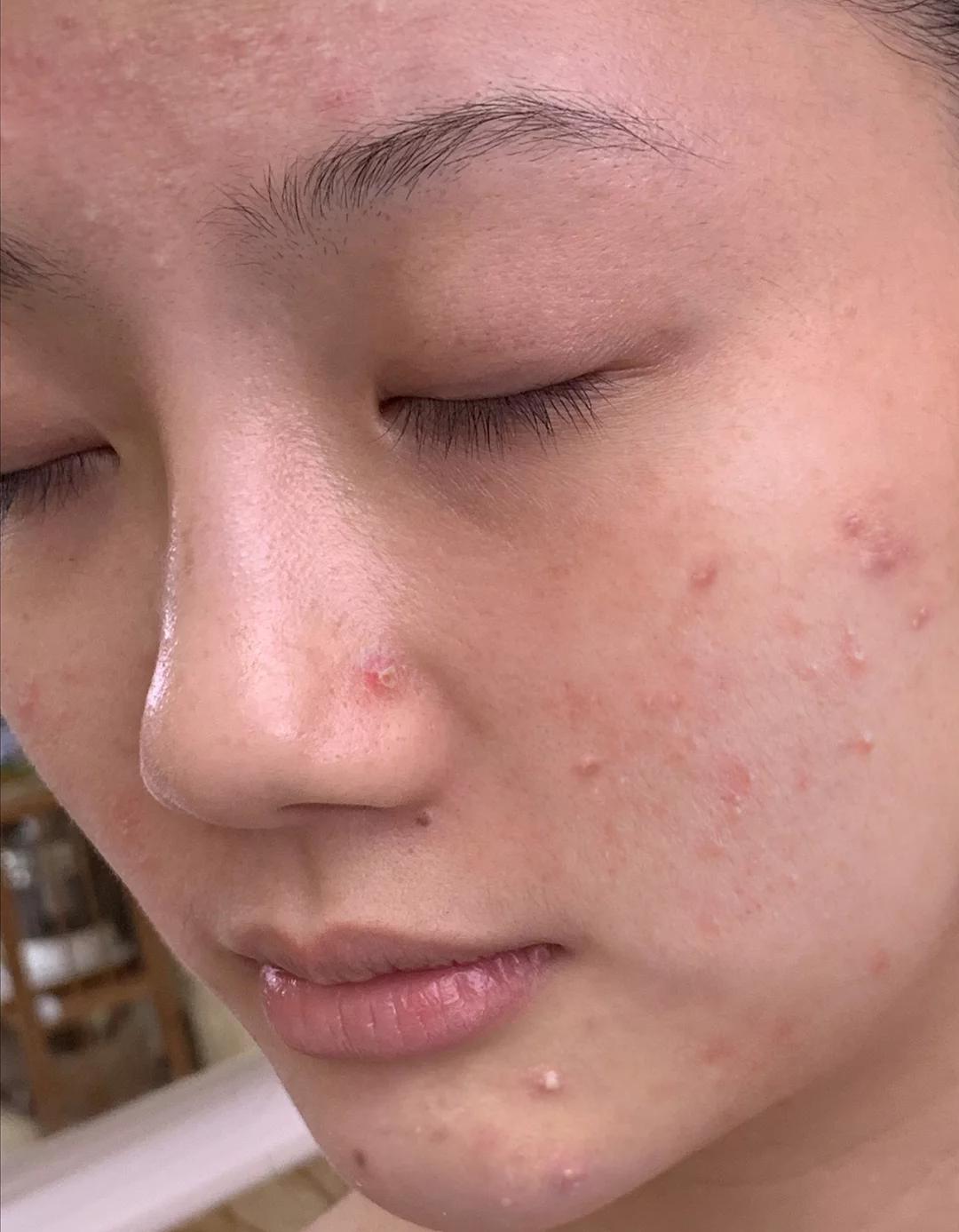 四个亲测有效的祛痘小妙招，坚持一个星期，不用花钱就有好皮肤