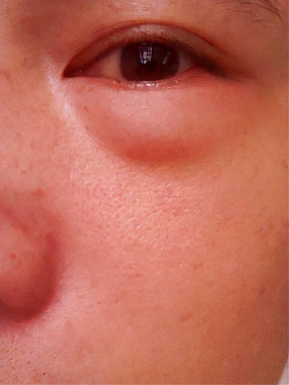 脚丫肿得很疼怎么缓解,脚丫子突然肿胀疼