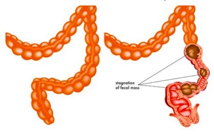 瘫痪老人长期便秘的危害,长期喝酒便秘有什么危害