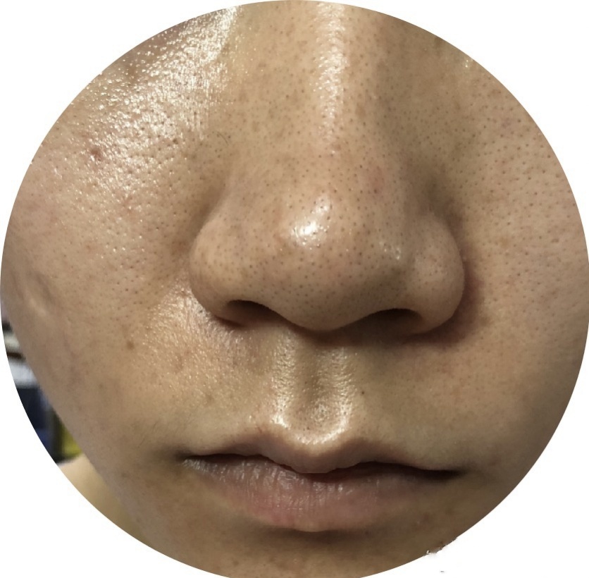 油皮毛孔大泛红怎么改善,干皮毛孔粗大怎么改善小妙招