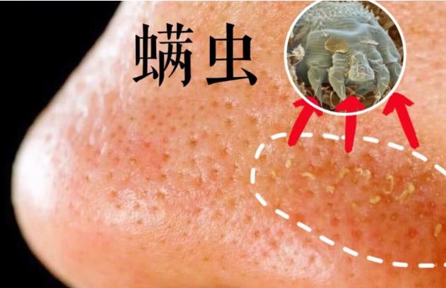 怎么分清螨虫造成的毛孔粗大,毛孔内螨虫怎么解决