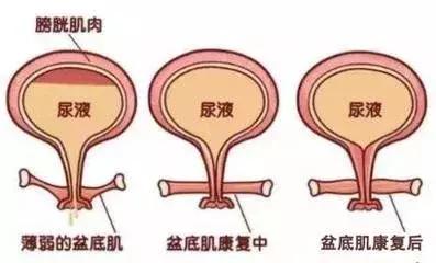 笑会流尿出来是什么原因,笑尿了正常吗健康科普