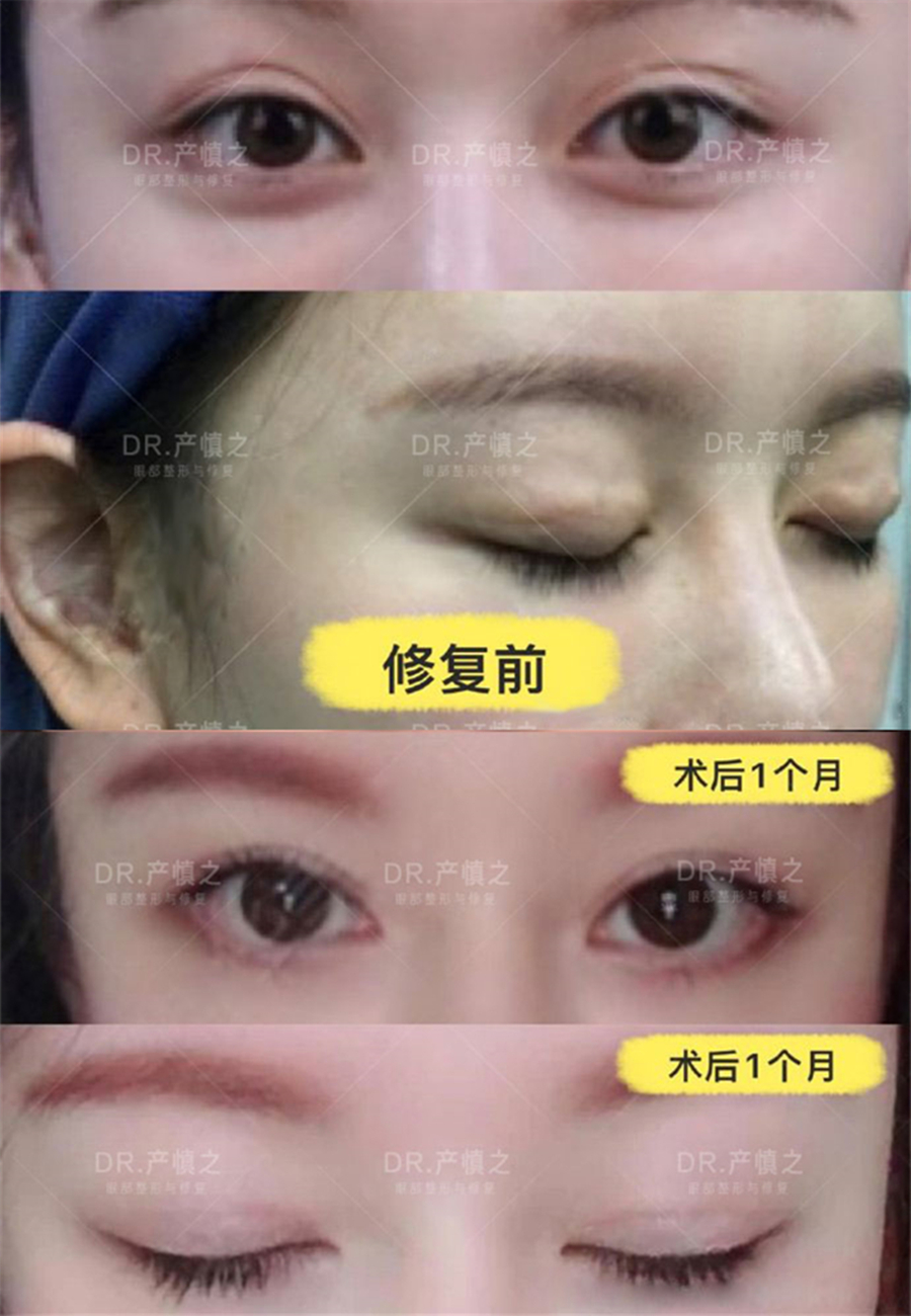 双眼皮疤痕凸起怎么回事,双眼皮两只眼睛疤痕不一样