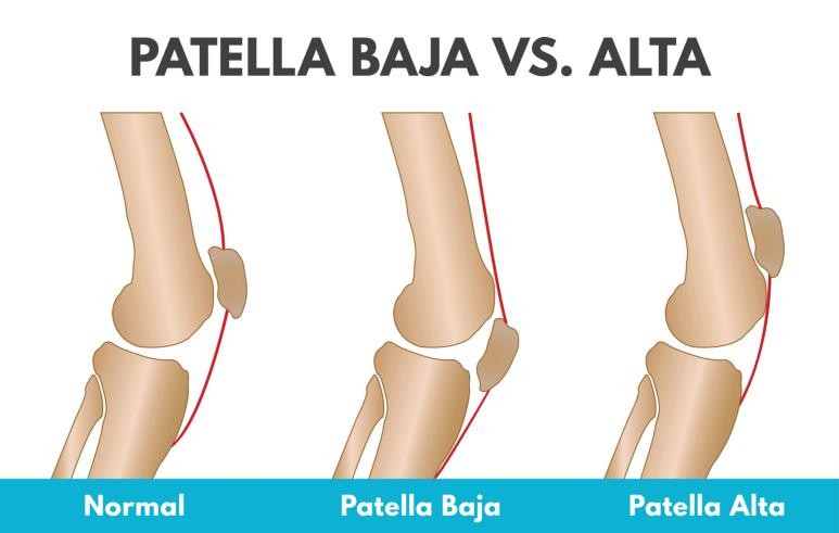 膝髌骨下方疼痛如何治,膝髌骨痛是什么原因引起的