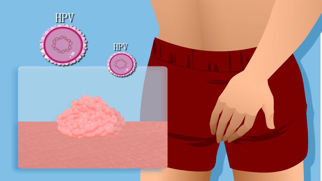 男生得了尖锐性湿疣一定得了hpv吗,小伙口腔长尖锐病毒湿疣