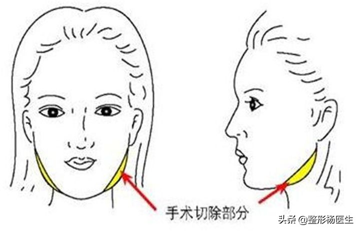 女生国字脸削骨头整容,国字脸女整形